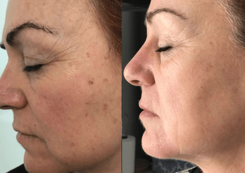 Anti-Ageing Treatments